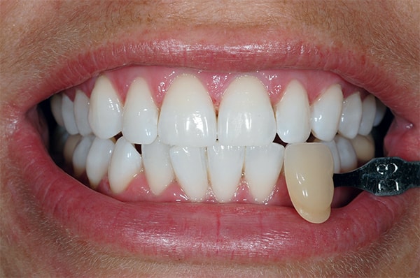 After teeth Whitening at West Dulwich Dental After teeth Whitening at West Dulwich Dental
