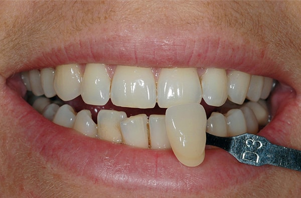 Before teeth Whitening at West Dulwich Dental Before teeth Whitening at West Dulwich Dental