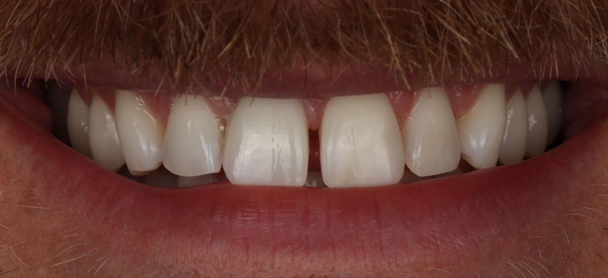 dental-implants