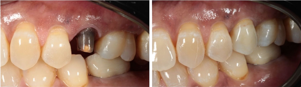 before-after-dental-implants